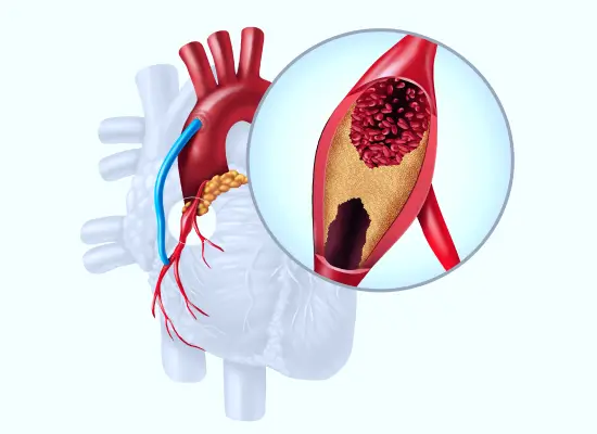 Angioplasty Surgery Procedure
