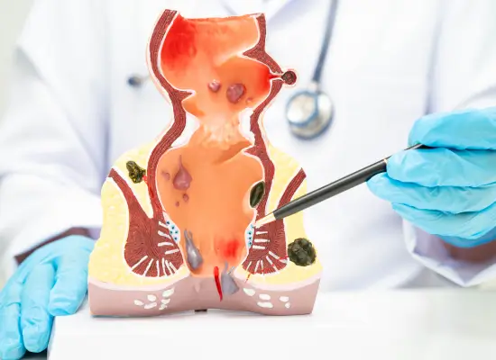 Preparation For Laser Or Open Hemorrhoidectomy