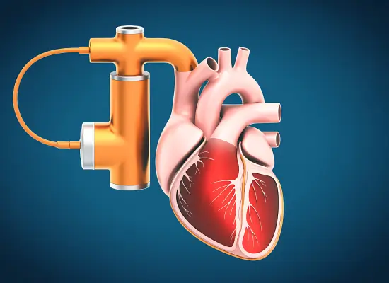 Who Is The Right Candidate For LVAD?
