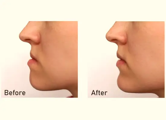 The Procedure of Jaw Correction Surgery