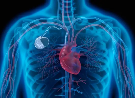 Pacemaker Insertion Surgery Procedure