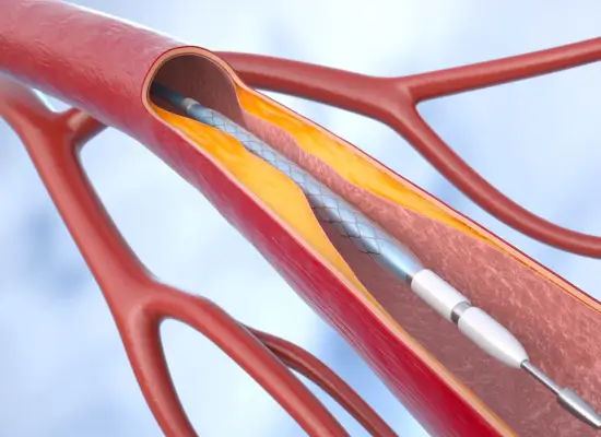 Types of Primary Angioplasty: