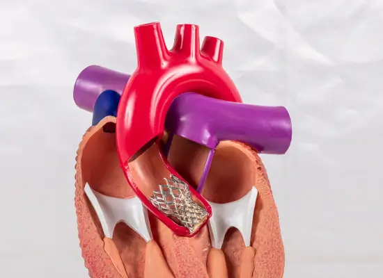 TAVI Procedure: How is it Done?