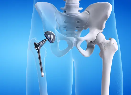 Preparation For Total Hip Replacement